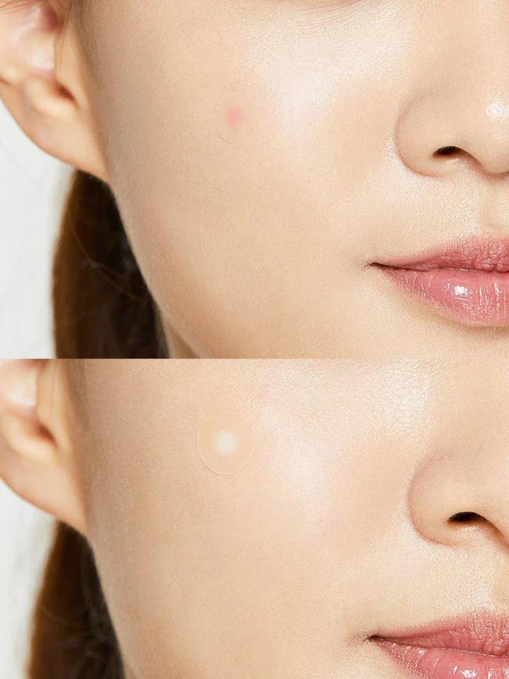 Acne Pimple Master Patch (24 parches)